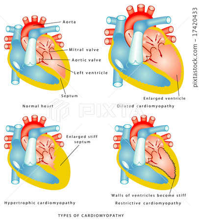 Diseases of the Heart Muscle 17420433