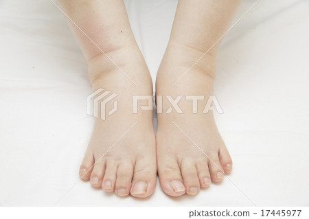 嚴重腫脹的腳 嚴重腫脹的腳 17445977