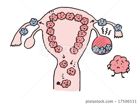 Endometriosis 17506531