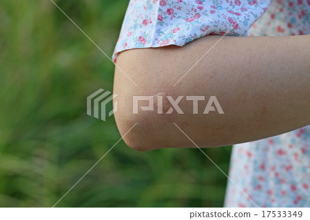 Eczema after mosquito bites 17533349