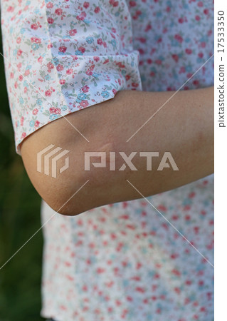 Eczema after mosquito bites 17533350