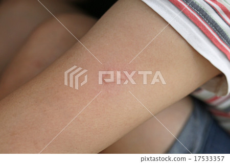 蚊蟲叮咬後的濕疹 17533357