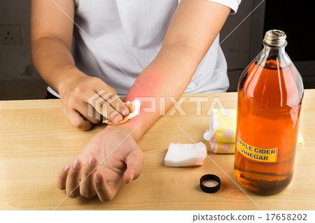 Apple cider vinegar remedy for skin itch & fungus Apple cider vinegar remedy for skin itch & fungus 17658202