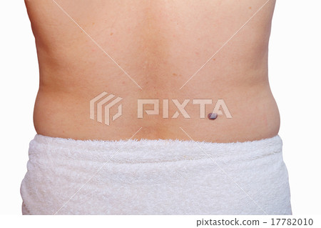 birthmark birthmark 17782010