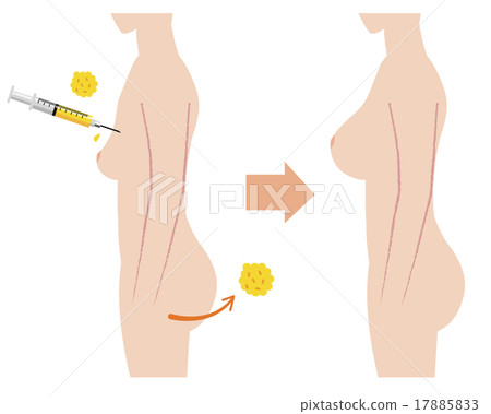 乳房乳房肥胖手術與身體側視 17885833