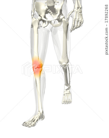 膝關節疼痛 17892268