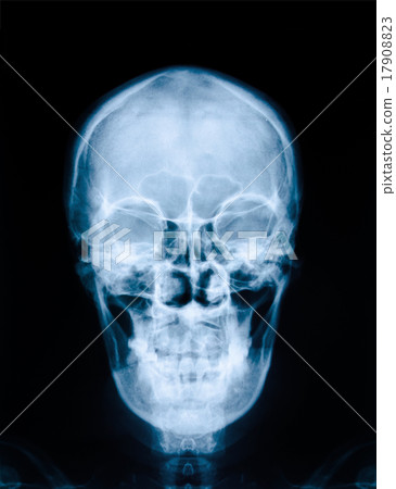 X-ray picture of skull X-ray picture of skull 17908823