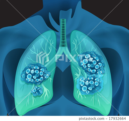 Lung cancer in human body Lung cancer in human body 17932664