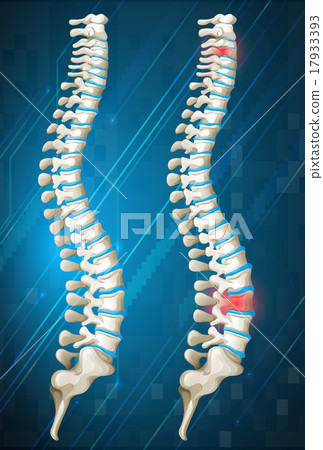 Human spines with red inflamed on one 17933393