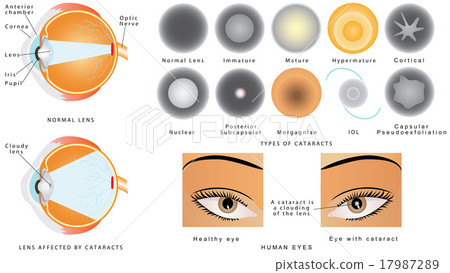Cataract 17987289