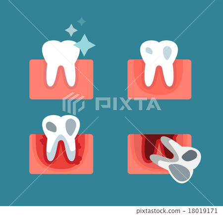 Periodontal disease stage steps vector 18019171