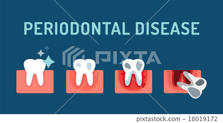 Periodontal disease stage steps vector 18019172
