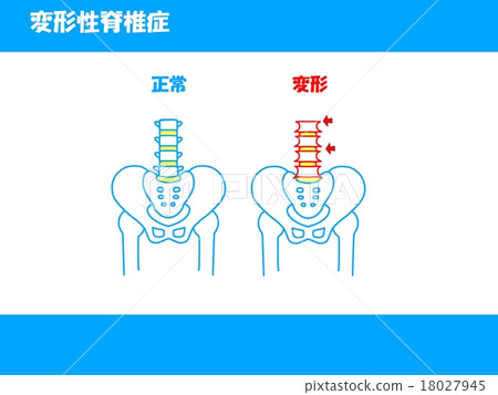 退行性脊椎病 18027945