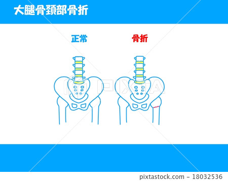 Femoral neck fracture 18032536