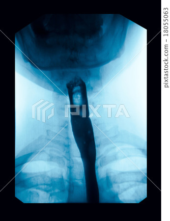The image of x-ray upper gastrointestinal (UGI). 18055063