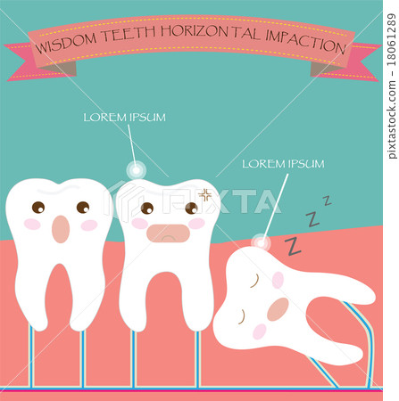 Wisdom Teeth Horizontal Impaction Wisdom Teeth Horizontal Impaction 18061289