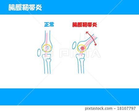 Iliotic韌帶 18107797