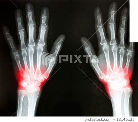 film X-Ray scan human 18146125