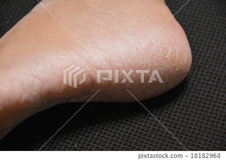 皮膚乾燥 18182968