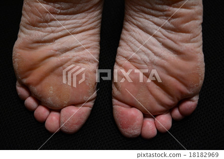 皮膚乾燥 皮膚乾燥 18182969