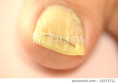 治療腳拇指腳趾甲 18253712