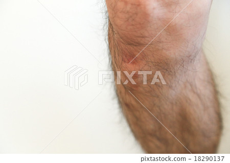 Osgood病的生長疼痛 Osgood病的生長疼痛 18290137