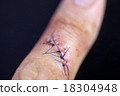 Finger injury 18304948