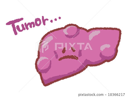 Tumor formed with liver character 18366217