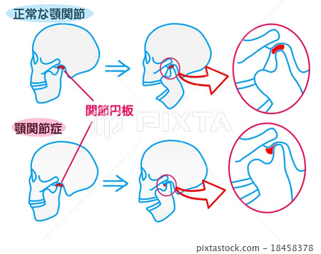 Temporomandibular disorders 18458378