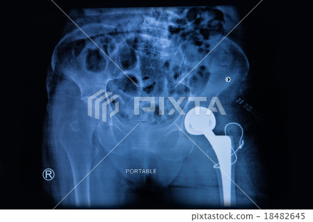 X-ray of the hip endoprosthesis in elderly woman,  18482645