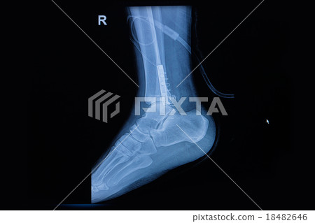 Fracture of the lower part of the fibula 18482646