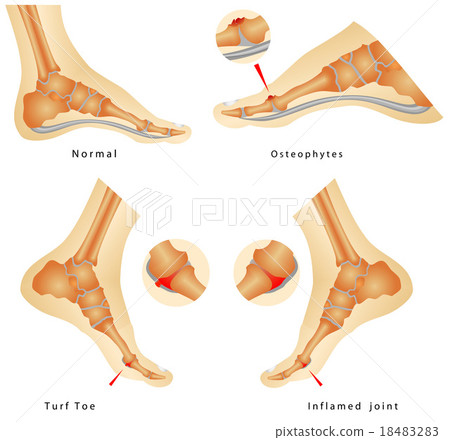 Turf Toe Turf Toe 18483283