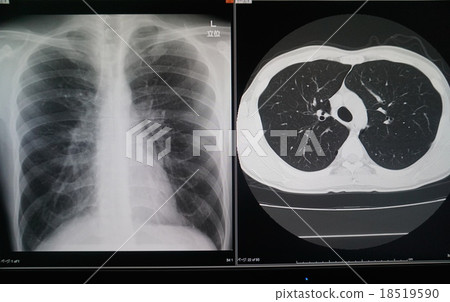 胸部Xp，CT 18519590
