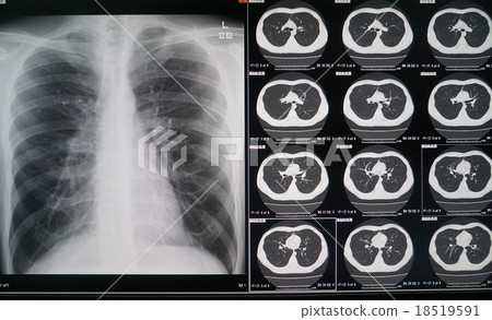 胸部Xp，CT 18519591