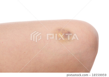 Bruise on wounded woman leg skin Bruise on wounded woman leg skin 18559959