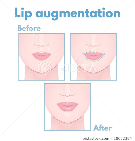 plastic surgery lip 18632394