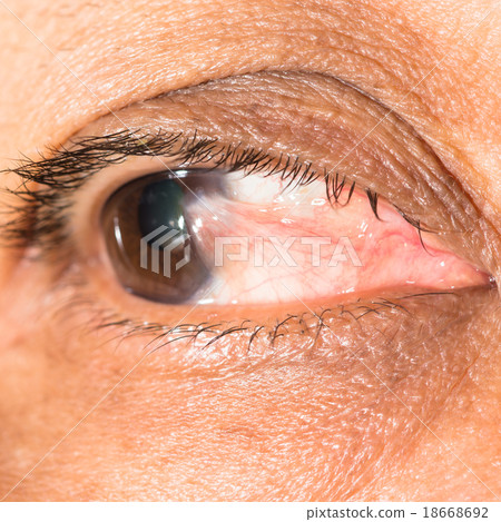 pterygium 18668692