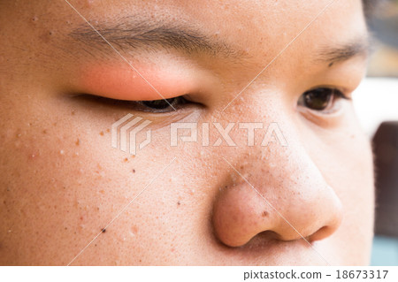 Swollen red upper eye lid with stye infection 18673317