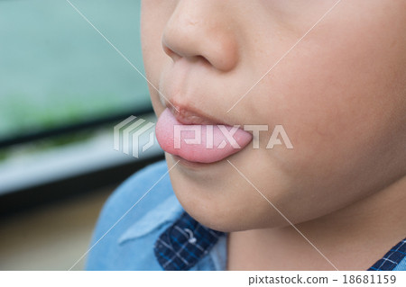 Tongue Tie Tongue Tie 18681159