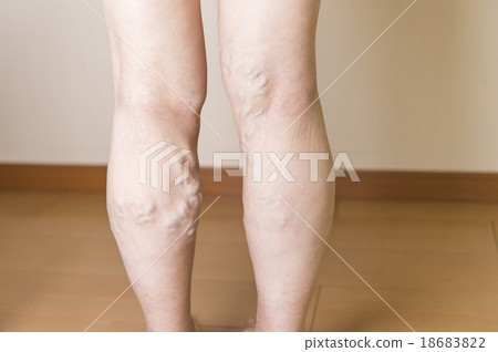 下肢靜脈曲張 18683822