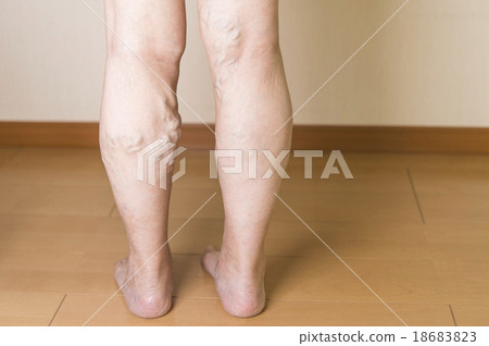 下肢靜脈曲張 18683823