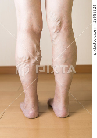 Lower extremity varix 18683824