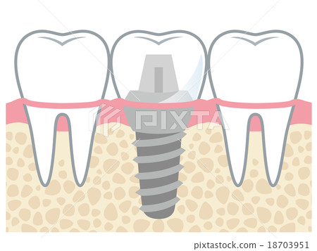 Tooth implant structure 18703951