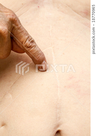the old man's stomach and a scar from the surgery. the old man's stomach and a scar from the surgery. 18770965