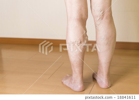 Lower extremity varix 18841611