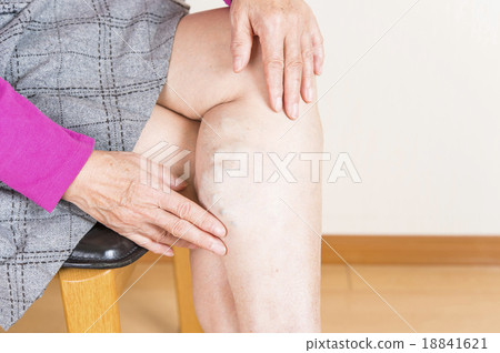 Lower extremity varix 18841621