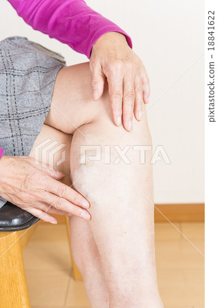 Lower extremity varix 18841622