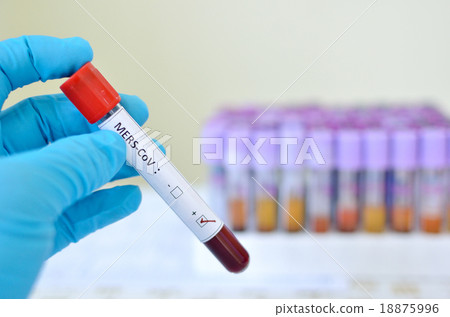 Blood sample with MERS virus positive 18875996