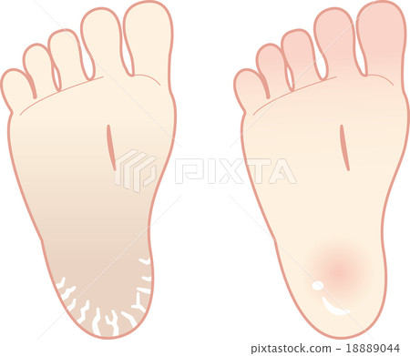 之後的鞋跟護理 18889044