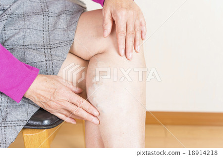 Lower extremity varix 18914218